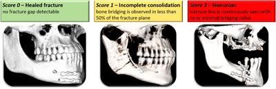 Prognostic implications of a CD8+ TEMRA to CD4+Treg imbalance in mandibular fracture healing: a prospective analysis of immune profiles